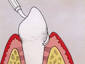 Subgingival Scaling