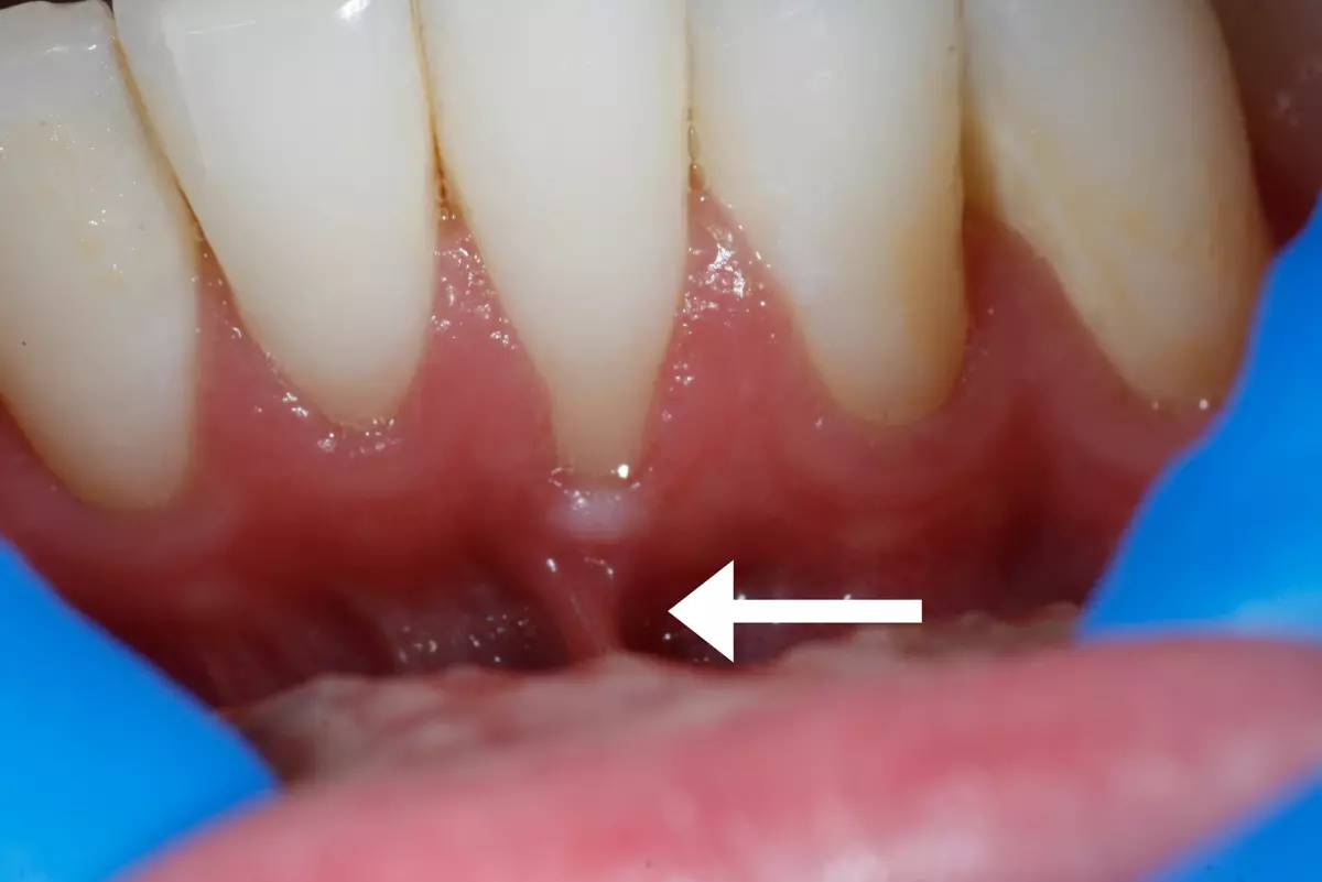 Before: Frenum Pull Between Teeth
