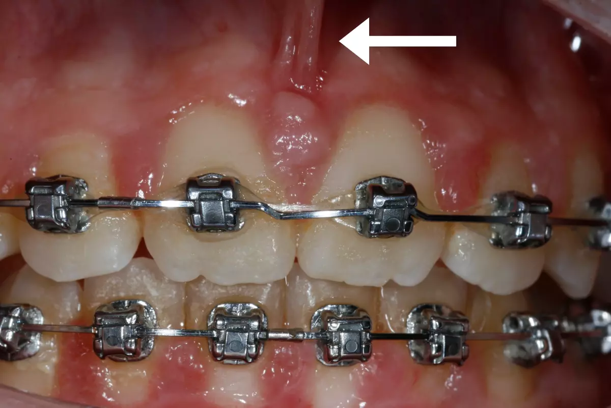 Frenum Pull Between Front Teeth (F)