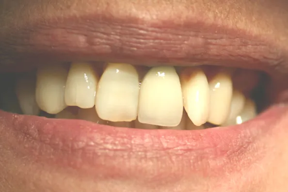 Teeth Lost Due to Bone Loss