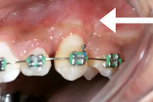 After: Canine Exposed and Moved