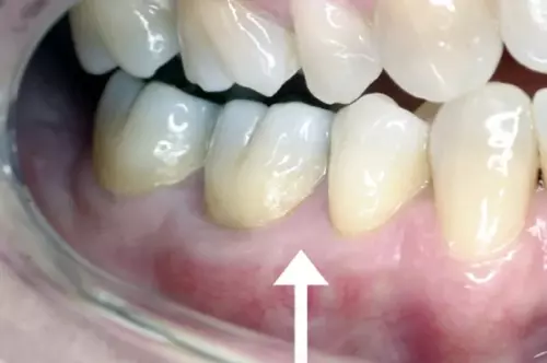 After: Gum is Healthy