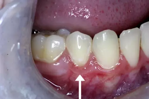 After: Gum is Healthy