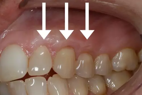After: Gums are Healthy