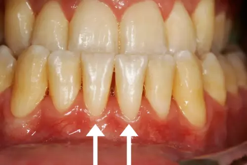 Multiple Soft Tissue Grafts