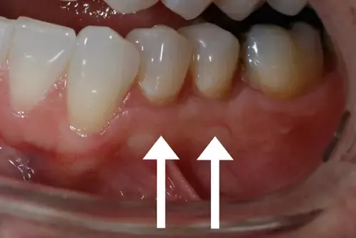 After: Gums are Healthy