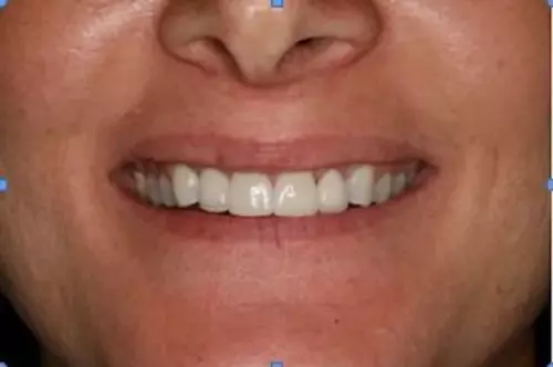 After: Healthy Gums Under Bridge