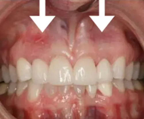 After: Healthy Gums Under Bridge