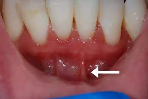 After: No Frenum Pull Between Teeth