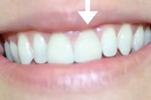 After: Normal Length and Healthy Gums