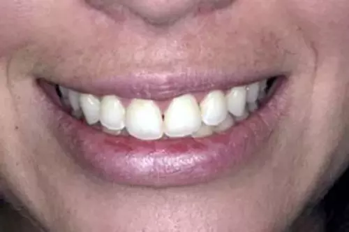 After: Normal Length and Smooth Gums