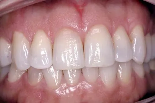 After: Normal Length and Smooth Gums