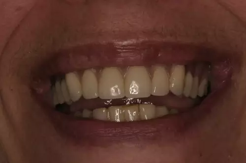 After Smile with Implants