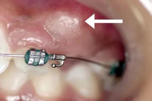 Before: Canine Under the Gum