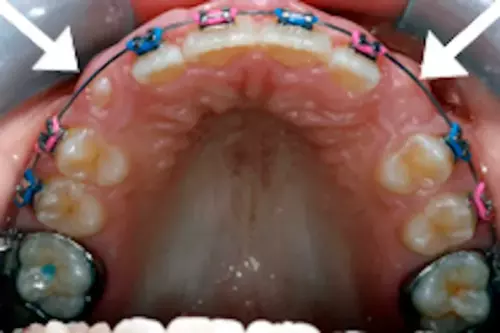 Before: Canines Not Erupting