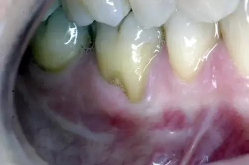 Before: Receding Gum