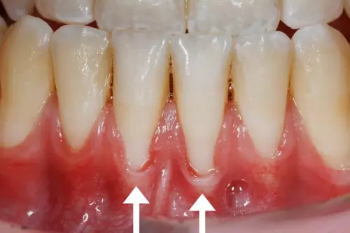 Before: Receding Gum