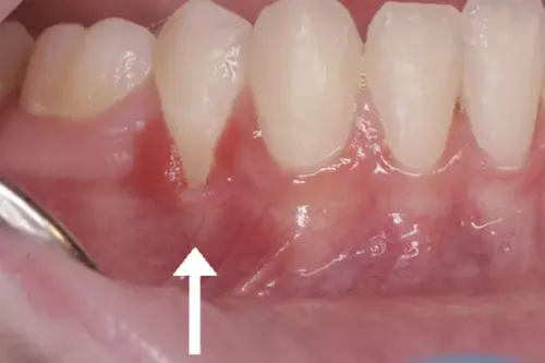 Before: Receding Gum