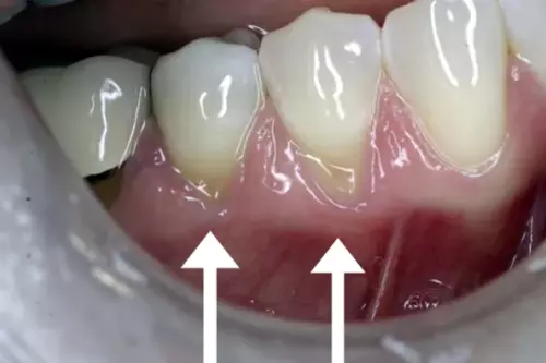 Before: Receding Gums