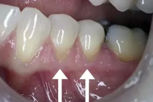 Before: Receding Gums