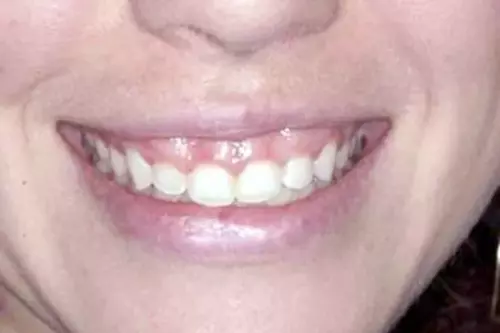 Before: Short Teeth and Thickened Gums