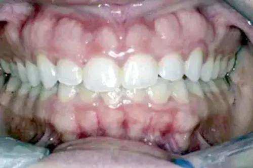 Before: Short Teeth and Thickened Gums