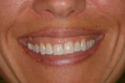 Before: Short Teeth and Thickened Gums