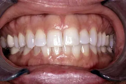 Before: Short Teeth and Thickened Gums