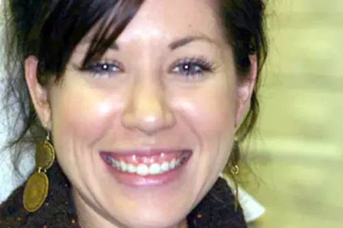 Before: Short Teeth and Thickened Gums