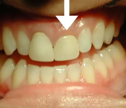 Before: Short Teeth and Uneven Gums