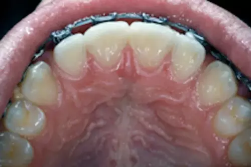Frenum Pull Between Front Teeth (L)