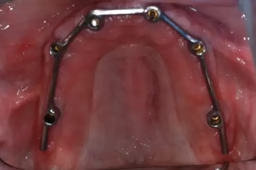 Implants with a Bar on Upper