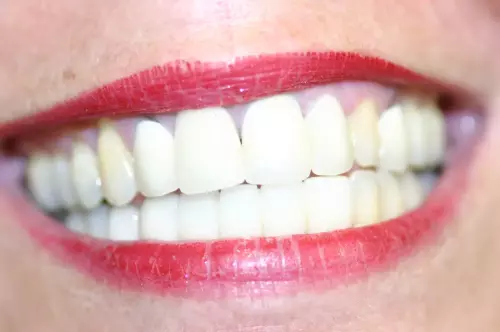 Multiple Implants: Fixed (Non-Removable) Teeth