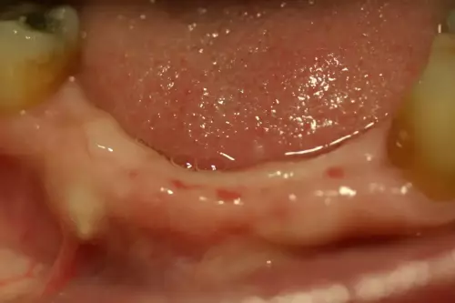 Multiple Implants: Fixed (Non-Removable) Teeth