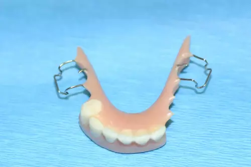 Multiple Implants: Fixed (Non-Removable) Teeth