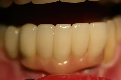 Multiple Implants: Fixed (Non-Removable) Teeth