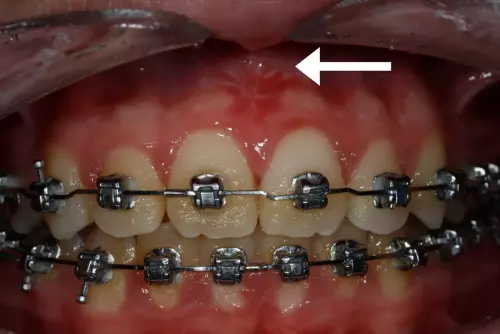 No Frenum Pull Front Teeth (F)