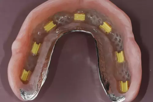 Removable Prosthesis for Upper