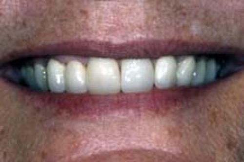 Single Tooth Implant