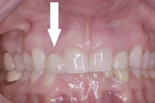 Single Tooth Implant
