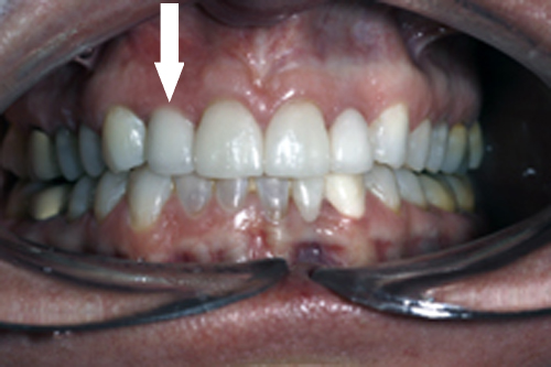 Single Tooth Implant
