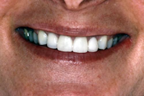 Single Tooth Implant