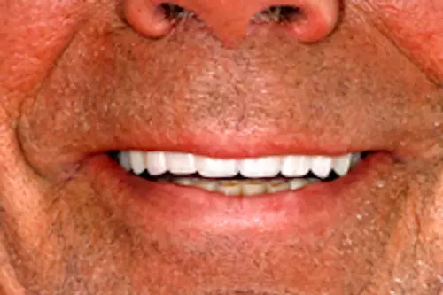 Smile After Implants