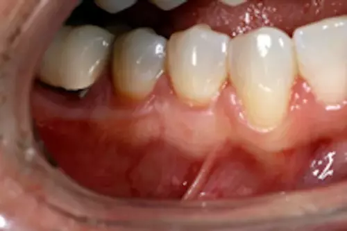 Smile After Implants